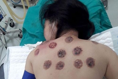 Hoại tử da vì giác hơi trị đau vai gáy