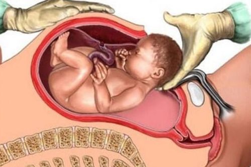 Sản phụ bất ngờ bị sốc phản vệ nguy hiểm tính mạng sau khi sinh mổ