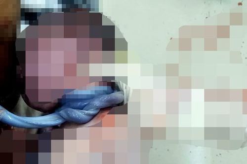 Một trẻ sơ sinh bị dây rốn quấn 3 vòng quanh cổ chào đời an toàn