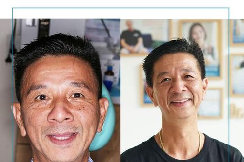 Việt kiều Mỹ về nước trồng răng Implant để tiết kiệm chi phí