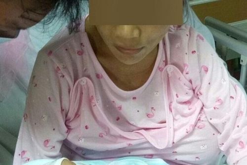 Sản phụ quyết vượt cạn dù mắc u vú từ tuần thai thứ 26