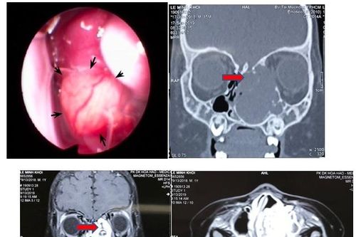 Bé trai 1 tuổi lồi mắt, nghẹt mũi hóa ra thủ phạm là khối u lớn
