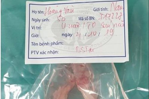 Người đàn ông suy giảm trí nhớ do ổ nang sán cư trú trong não