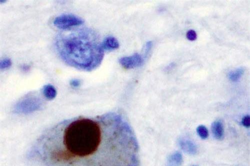 Hướng điều trị mới cho bệnh nhân Parkinson