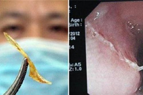Bệnh nhân bị hóc xương cá gây áp xe trung thất nguy hiểm