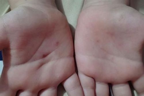 Làm rõ nghi vấn giáo viên mầm non dùng vật nhọn đâm vào tay học sinh