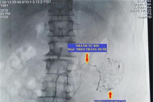 Lần đầu tiên can thiệp ung thư gan di căn bằng nút động mạch hóa chất