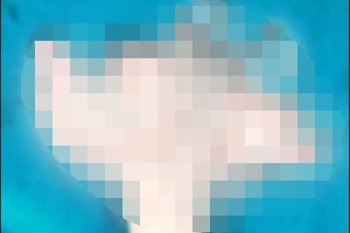 Nổ điện thoại, bàn tay cậu bé 16 tuổi dập nát