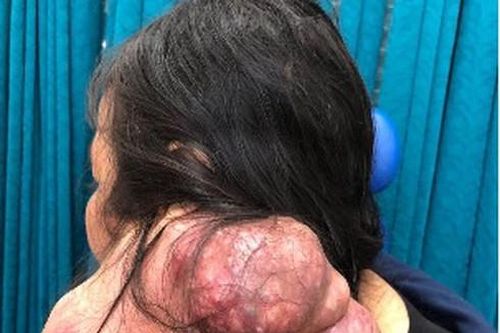 Phẫu thuật khối u khổng lồ đeo bám suốt 25 năm cho một phụ nữ
