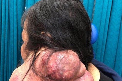 Một phụ nữ được phẫu thuật thành công khối u vùng cổ khổng lồ hiếm gặp