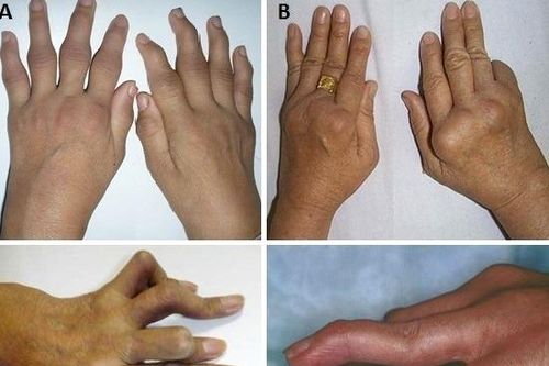 Tự ý điều trị bằng thuốc nam chữa khớp, người đàn ông suýt tàn phế