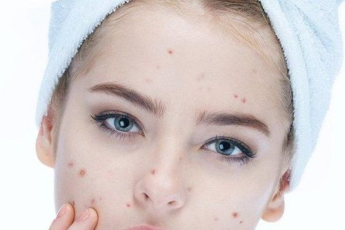 Tạm biệt mụn với những thực phẩm quen thuộc hằng ngày