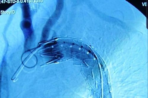 Người đàn ông suýt chết sau tai nạn giao thông khi bị vỡ eo động mạch chủ