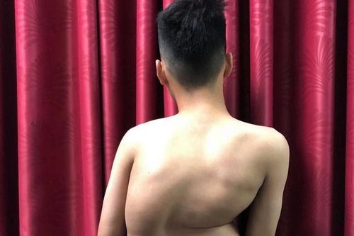 Chàng trai 17 tuổi cao thêm 8 cm sau ca mổ vẹo cột sống