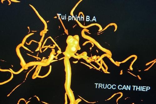 Cứu sống bệnh nhận bị vỡ túi phình mạch máu não nguy kịch