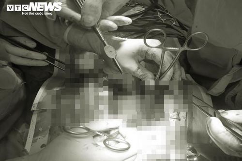 Cứu sống kịp thời người phụ nữ bị vỡ tim do tai nạn giao thông