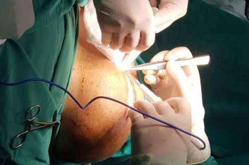 Phẫu thuật thành công khối bướu trên cổ nặng hơn 3kg