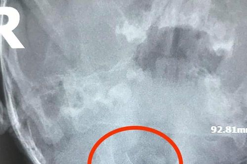 Bé 13 tháng tuổi ở Nghệ An nuốt phải mảnh thép sau khi ăn cháo mua sẵn