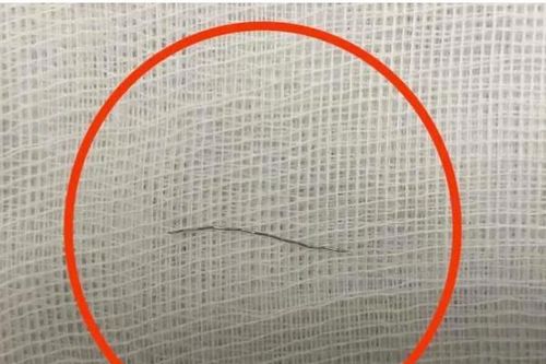Ăn cháo mua sẵn, bé gái 13 tháng tuổi nuốt phải đoạn thép mảnh dài 2cm