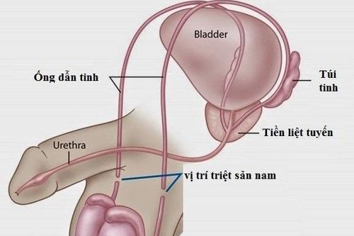Triệt sản như ca sĩ Hoàng Bách liệu có ảnh hưởng đến 'bản lĩnh phái mạnh' của nam giới?