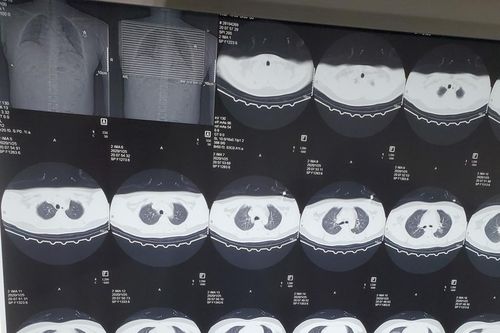 Hình ảnh phổi của bệnh nhân bị virus corona phá hủy