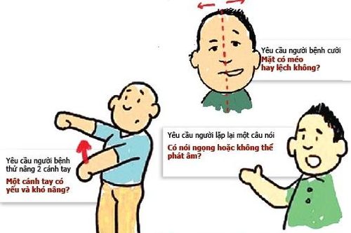 Dùng thuốc chống đông không thường xuyên, bệnh nhân hẹp van 2 lá bị đột quỵ