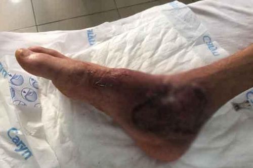 Suýt mất chân vì tự điều trị thuốc nam tại nhà