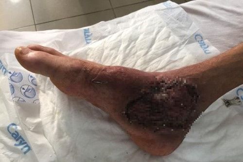 Suýt mất chân do tự điều trị thuốc nam tại nhà