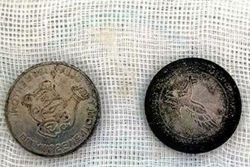 Bé trai 7 tuổi nuốt chửng 2 đồng xu có đường kính 2cm