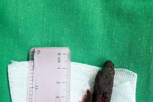 Bé trai 8 tuổi bị khúc gỗ đâm xuyên mũi