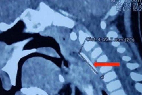 Đang đùa nghịch, bệnh nhi 18 tháng tuổi bị cây nĩa nhựa đâm xuyên họng