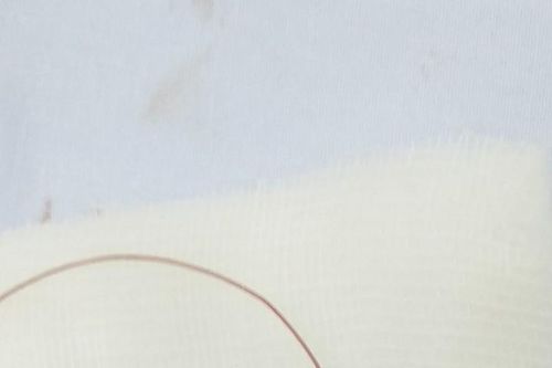 Tổn thương thị lực tới 99% vì bị lưỡi câu móc trúng mắt khi đi câu cá