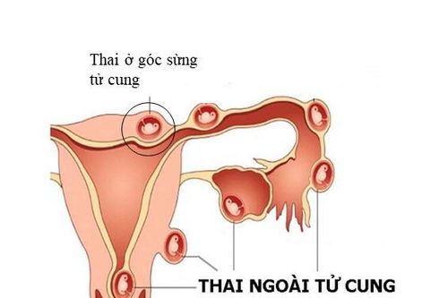 Cứu sống thai phụ vỡ song thai ngoài tử cung hiếm gặp