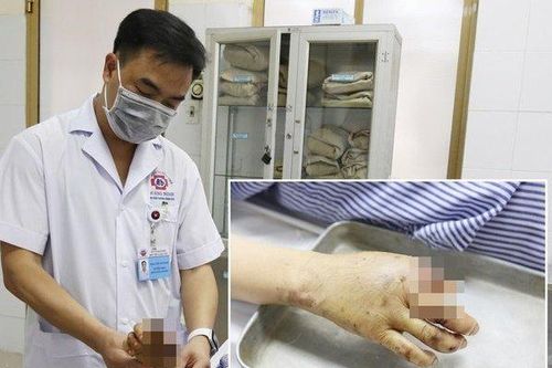 Một người phụ nữ bị máy xay thịt nghiền nát tay: Các bác sĩ đưa ra khuyến cáo