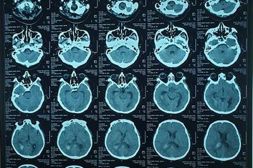 Thanh niên 37 tuổi huyết áp cao bất ngờ máu tràn não thất