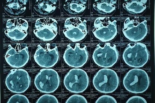 Áp dụng kỹ thuật mới cứu sống người xuất huyết não tại Đồng bằng sông Cửu Long