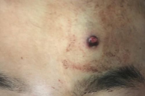 Nhóm thanh niên dùng súng tự chế đi săn đêm, một người bị đạn bắn xuyên não