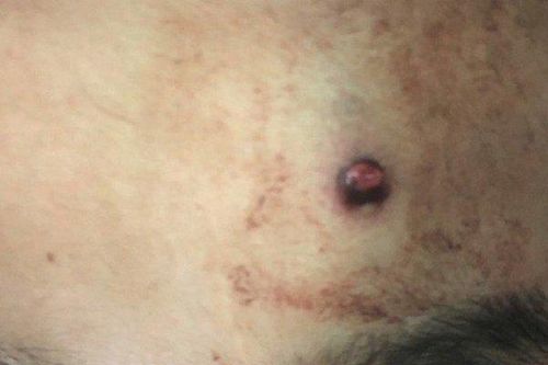 Nam thanh niên bị đạn bắn xuyên não khi đi săn cùng bạn: Ẩn họa khôn lường từ súng tự chế