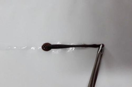 Gắp thành công con đỉa chui vào mũi nữ bệnh nhân