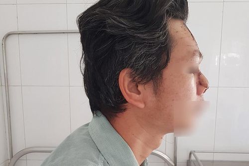 'Tìm lại' mũi cho bệnh nhân sau khi cắt bỏ khối u