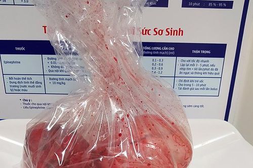 Cắt khối u xơ 'khủng', nặng 3 kg
