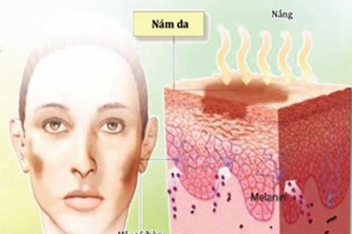 Đánh bay vết nám