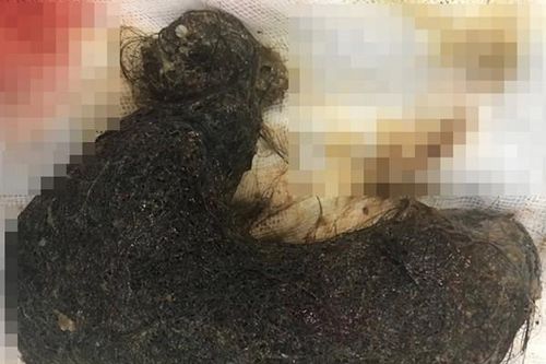 Hy hữu: Lấy khối u tóc khổng lồ trong bụng bé gái có thói quen ăn... tóc suốt 9 năm