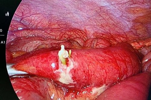 Nuốt nhầm xương cá người đàn ông phải cắt đoạn ruột non