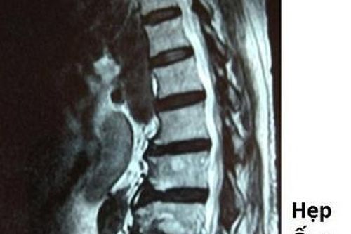 4 giờ phẫu thuật cho bệnh nhân nhiều đêm phải ngủ 'ngồi'