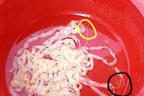Phát hiện cặp sán xơ mít dài 10 mét trong cơ thể người đàn ông