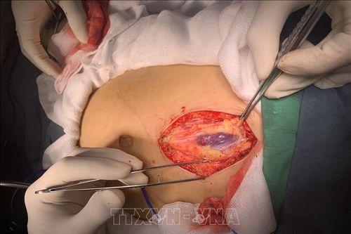 Can thiệp cứu sống kịp thời bệnh nhi bị vỡ lách do tai nạn sinh hoạt