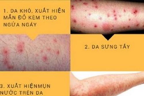 Điểm mặt bệnh da thường gặp vào mùa hè