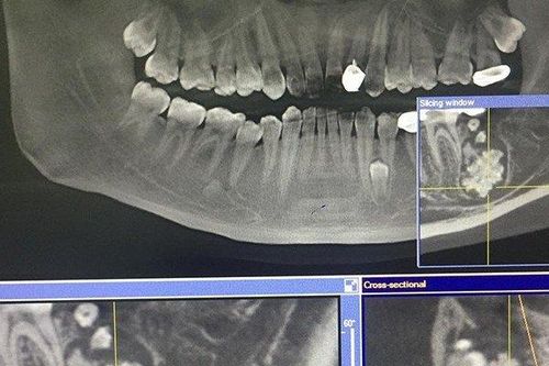 Nam thanh niên ở Hà Nội có khối u lạ chứa nhiều răng nhỏ trong miệng