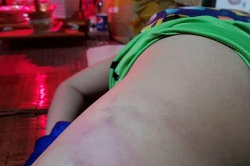 Phụ huynh tố giáo viên chủ nhiệm đánh học sinh bầm tím cơ thể